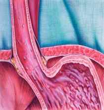 Barrett's Esophagus