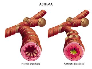 Acid reflux and asthma, how does one condition cause another?